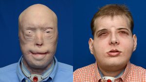 26-hour face transplant made possible with